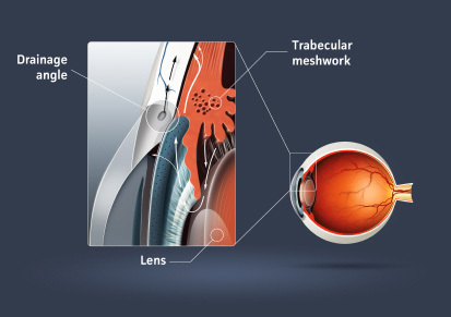 glaucoma