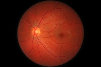 Proliferative diabetic retinopathy