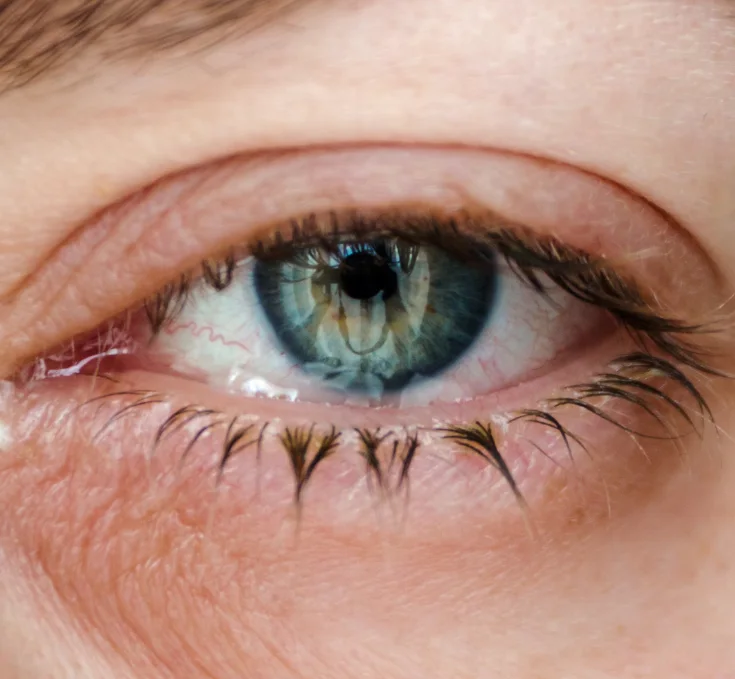 Macular-Degeneration img