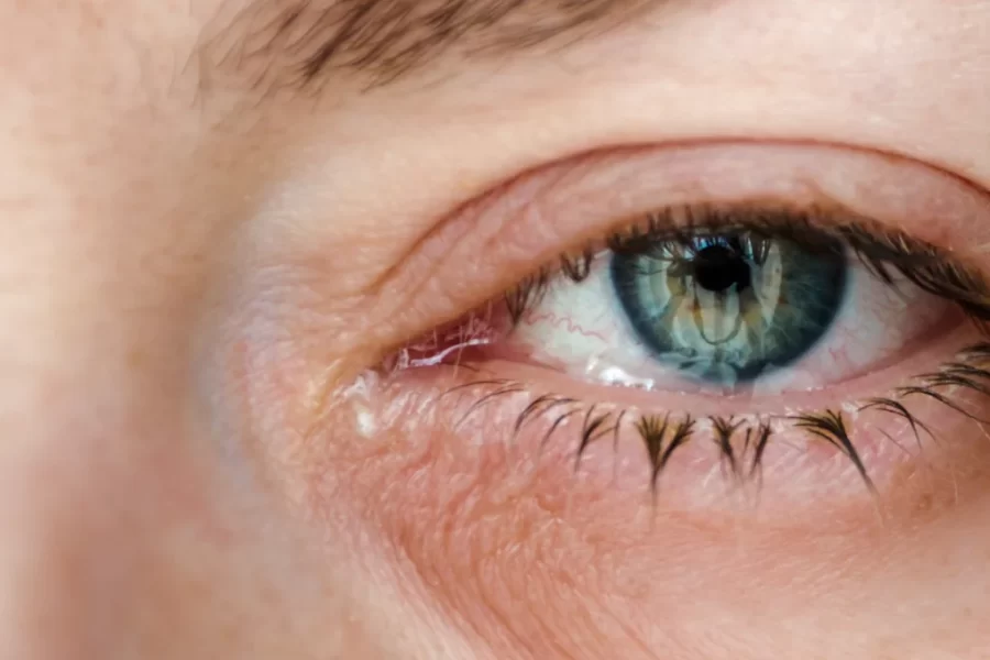 Macular Degeneration